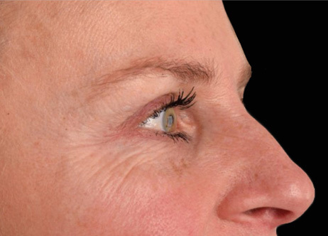 Vorher-Bild: Gesicht vor der Exion-Anwendung mit ausgeprägten Augenfalten.