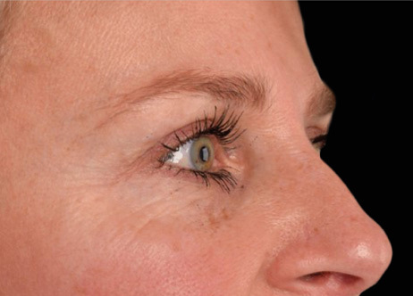 Nachher-Bild: Gesicht nach der Exion-Anwendung mit reduzierten Augenfalten.