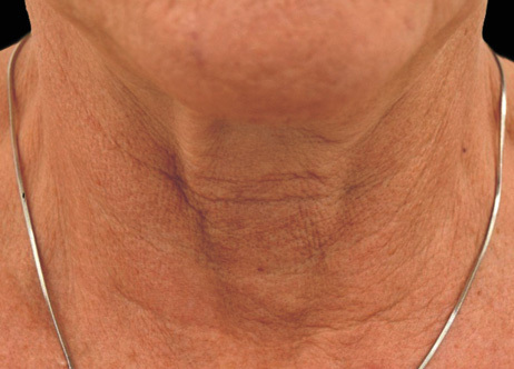 Vorher-Bild: Hals vor der Exion-Behandlung mit sichtbaren Zeichen der Hautalterung und Erschlaffung.