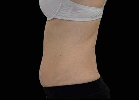 Vorher-Bild: Seitliche Ansicht des Bauches vor der Exion-Behandlung mit mangelnder Hautstraffheit und Kontur