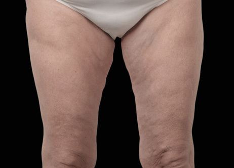 Nachher-Bild: Oberschenkel nach der Exion-Behandlung, zeigt deutlich straffere und glattere Haut