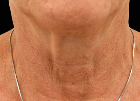 Nachher-Bild: Hals nach der Exion-Behandlung mit strafferer Haut und reduzierten Alterserscheinungen.
