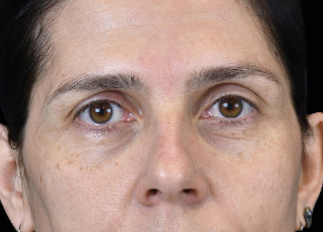 Nachher-Bild: Augenpartie nach der Exion-Behandlung mit sichtbarer Hautverjüngung.