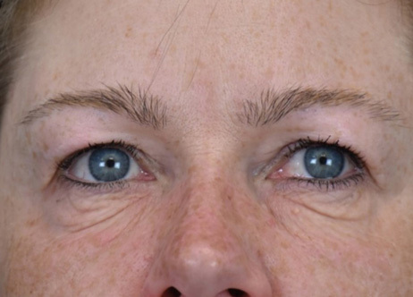Vorher-Bild: Gesicht vor der Exion-Behandlung mit sichtbarer Hauterschlaffung.