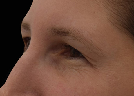Vorher-Bild: Gesicht vor der Exion-Behandlung mit sichtbaren Alterszeichen.