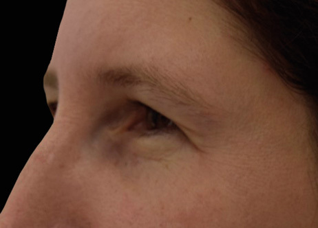 Nachher-Bild: Gesicht nach der Exion-Behandlung mit sichtbarer Hautverjüngung.