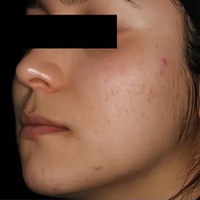 Vorher-Nachher-Bild einer Patientin mit Akne: Deutliche Hautverbesserung nach AviClear Behandlung in Rheda-Wiedenbrück