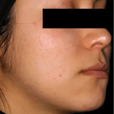 Seitenansicht des Gesichts einer Frau mit deutlich verbessertem Hautbild nach AviClear Behandlung in Rheda-Wiedenbrück