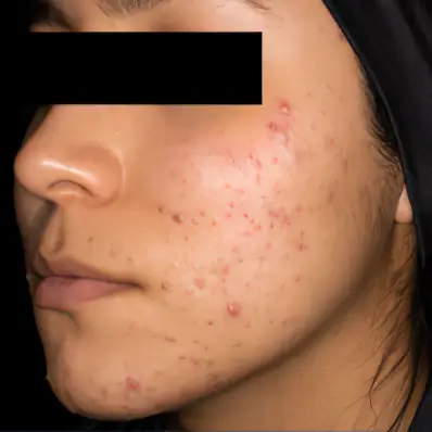Vorher-Nachher-Bild einer Patientin mit Akne: Starker Aknebefall vor AviClear Therapie in der HAUTarztpraxis Dr. Haut Rheda-Wiedenbrück
