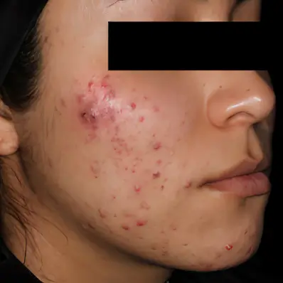 Seitenansicht des Gesichts einer Frau mit starkem Aknebefall vor AviClear Behandlung in Rheda-Wiedenbrück